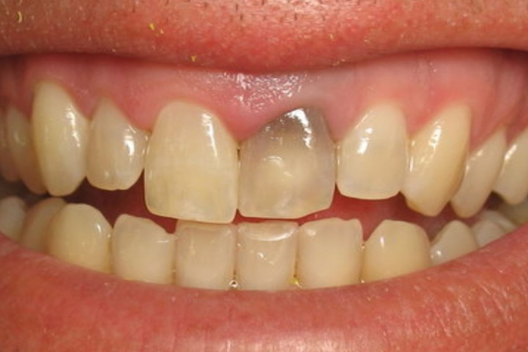 a gray tooth of a child