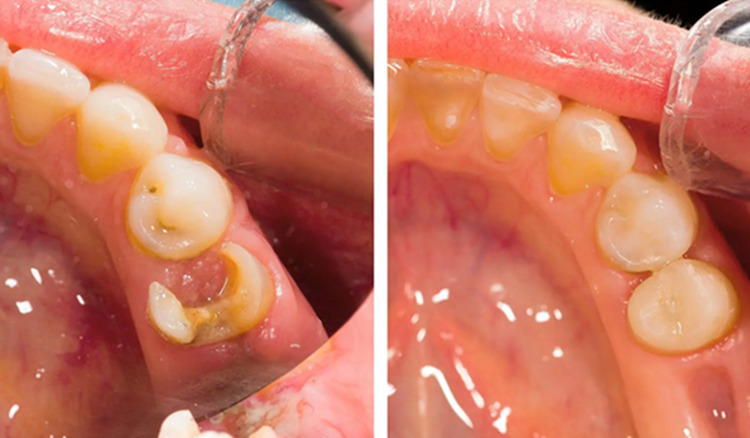 ceramic or procelain dental fillings