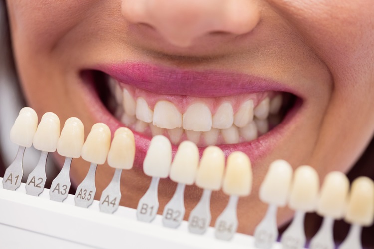 different colors of Porcelain Veneers