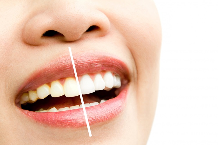 Teeth Whitening, one of the most popular cosmetic dental procedures