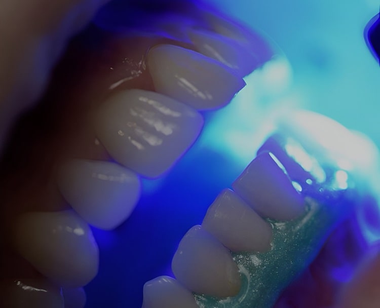 a method for whitening teeth 