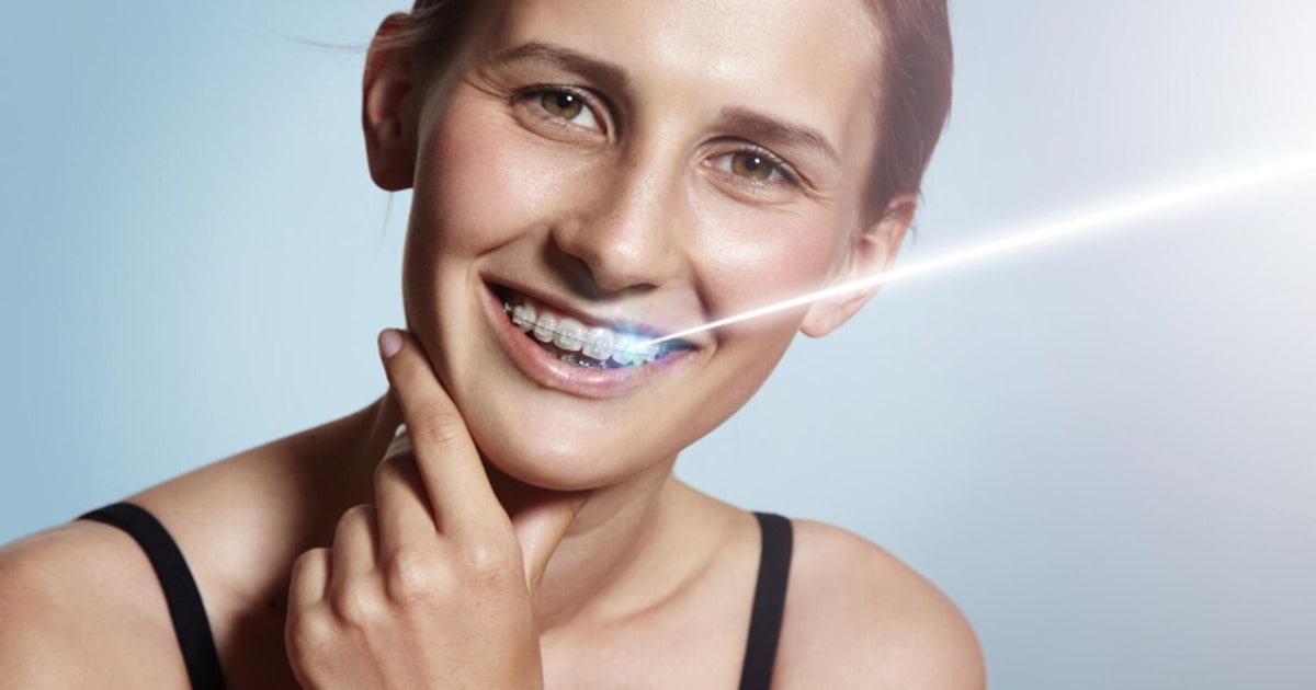 Teeth Whitening After Orthodontics: Best Options for Lasting Results