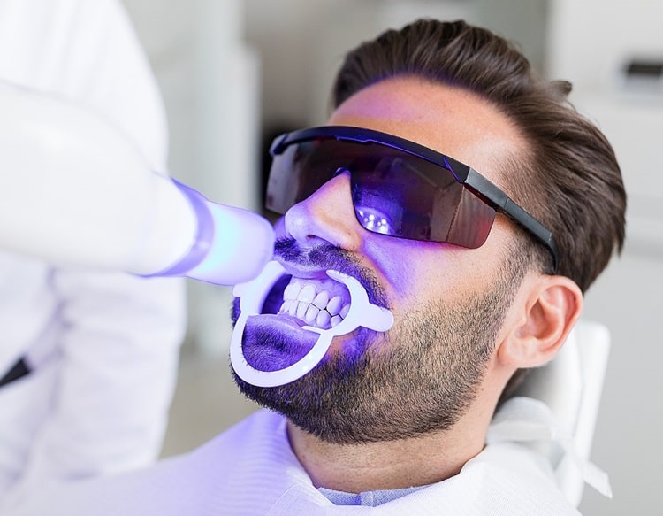Professional In-Office Bleaching for teeth whitening after Orthodontics