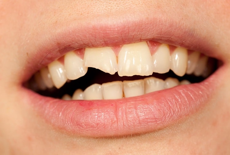 broken tooth due to sensitivity