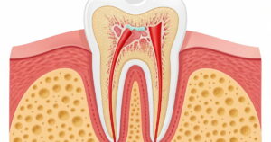 a photo of what a dental abscess is and what the dental abscess treatments are