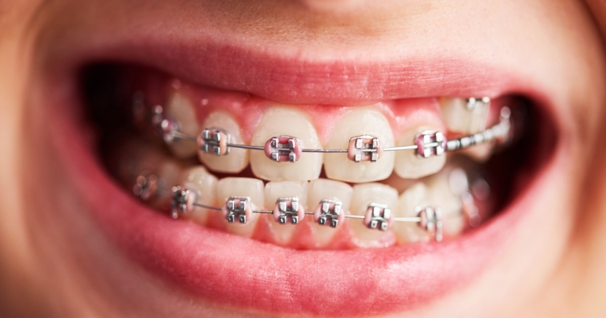 Braces Cost in Canada: Your 2026 Cost & Savings Guide
