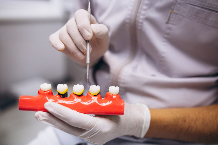 a photo showing a dentist holding dental crowns, mentioning when CDCP covers dental crowns