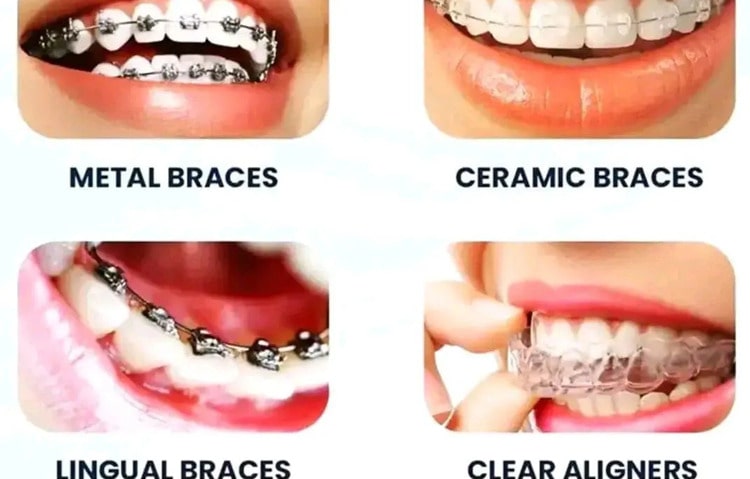 Types of Braces 