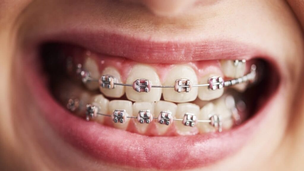 Types of Orthodontic Treatments