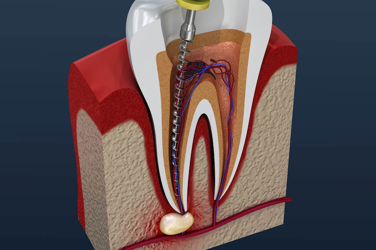 an illustration of root canal treatment under CDCP coverage in 2026