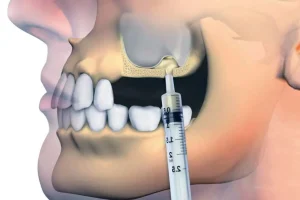 Benefits of Sinus Lifting
