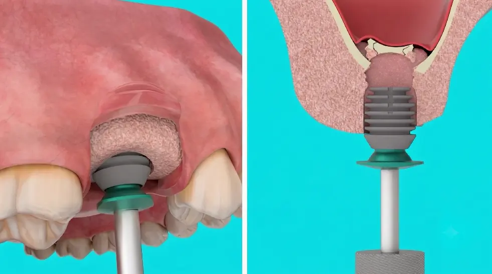 Sinus Lift Surgery North York